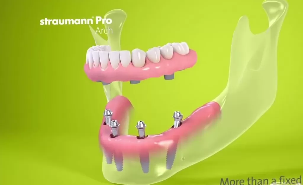 Все решения имплантов Штрауман исключительно надежны и дают предсказуемый результат при имплантации зубов